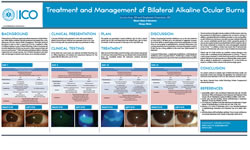 Jessica Jose, OD and Stephanie Fromstein, OD Treatment and Management of Bilateral Alkaline Ocular Burns