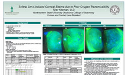 Scleral Lens Induced Corneal Edema due to Poor Oxygen Transmissibility
