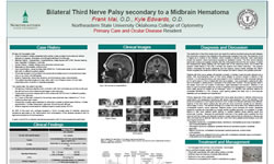 Bilateral Third Nerve Palsy secondary to a Midbrain Hematoma
