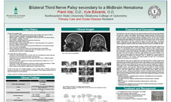 Bilateral Third Nerve Palsy secondary to a Midbrain Hematoma