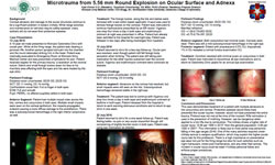 Microtrauma from 5.56 mm Round Explosion on Ocular Surface and Adnexa