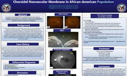 Choroidal Neovascular Membrane in African-American Population