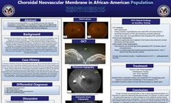 Allison Schafers, O.D., Hirangi Patel, O.D., Steven Grondalski, O.D., F.A.A.O., Julia Pulliam, O.D., F.A.A.O Choroidal Neovascular Membrane in African-American Population