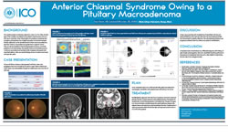 Anterior Chiasmal Syndrome Owing to a Pituitary Macroadenoma