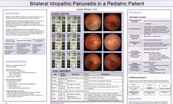Bilateral Idiopathic Panuveitis in a Pediatric Patient