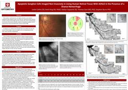 First Imaging Report of Evidence of Apoptotic Ganglion Cells in Living Human Tissue Associated With a Drance Hemorrhage