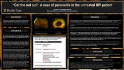 “Get the red out:” A case of Panuveitis in the untreated HIV patient.