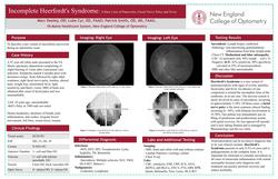 Incomplete Heerfordt's Syndrome: A Rare Case of Panuveitis, Facial Nerve Palsy and Fever.