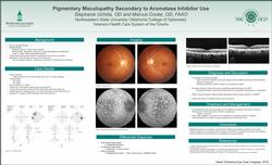 Pigmentary Maculopathy Secondary to Aromatase Inhibitor Use