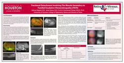 Familial Exudative Vitreoretinopathy (FEVR)