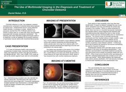 Multimodal Imaging in the Diagnosis and Treatment of Choroidal Osteoma