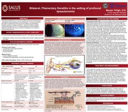 Bilateral, filamentary keratitis in the setting of profound dysautonomia