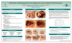 Evaluation and Management of an Advanced Case of Basal Cell Carcinoma