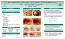 Evaluation and Management of an Advanced Case of Basal Cell Carcinoma