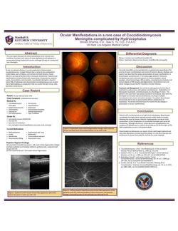 Ocular Manifestations in a rare case of Coccidioidomycosis Meningitis complicated by Hydrocephalus