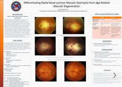 Differentiating Radial Basal Laminar Macular Dystrophy from Age Related Macular Degeneration