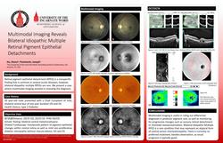 Multimodal Imaging Reveals Bilateral Idiopathic Multiple Retinal Pigment Epithelial Detachments