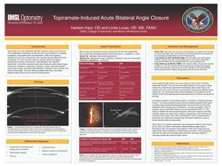 Vision Loss Due to Topiramate-Induced Acute Bilateral Angle Closure