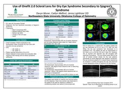 Use of Onefit 2.0 Scleral Lens for Dry Eye Syndrome Secondary to Sjogren’s Syndrome