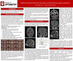 Bilateral Horizontal Gaze Palsy Secondary to CNS Lymphoma