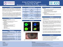 A case of familial pterygium and resulting anterior segment sequelae.