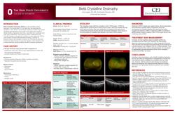 Bietti Crystalline Dystrophy
