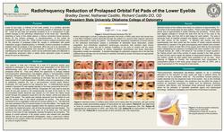 Radiofrequency Reduction of Prolapsed Orbital Fat Pads of the Lower Eyelids