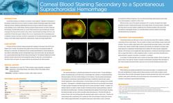 Corneal Blood Staining Secondary to a Spontaneous Suprachoroidal Hemorrhage
