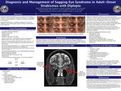 Diagnosis and Management of Sagging Eye Syndrome in Adult-Onset Strabismus with Diplopia