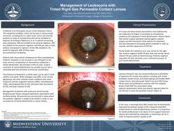 Management of Leukocoria with Tinted Rigid Gas Permeable Contact Lenses