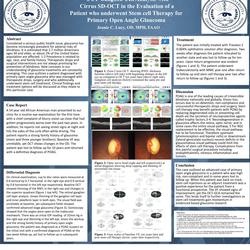 OCT Ganglion Cell analysis with Cirrus SD-OCT in the Evaluation of a patient who underwent stem cell therapy for Primary Open Angle Glaucoma