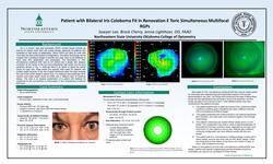 Patient with Bilateral Iris Coloboma Renovation E Toric Simultaneous Multifocal RGP