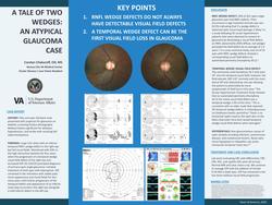 A Tale of Two Wedges: An Atypical Glaucoma Case