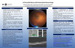 Sub-retinal hemorrhage overlying a choroidal nevus with no evidence of CNVM