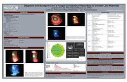 Diagnosis and Management of a Fungal Corneal Ulcer Secondary to Contact Lens Overwear