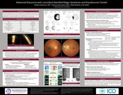 Advanced Glaucoma with Coincident Axenfeld-Rieger Syndrome and Pseudotumor Cerebri