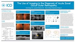 The Use of Imaging in the Diagnosis of Acute Zonal Occult Outer Retinopathy