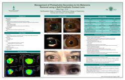 Management of Photophobia Secondary to Iris Melanoma Removal using Soft Prosthetic Contact Lenses