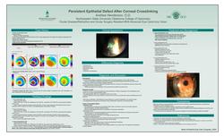 Persistent epithelial defect after corneal crosslinking
