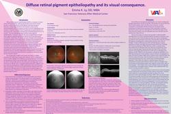 Diffuse retinal pigment epitheliopathy and its visual consequence.