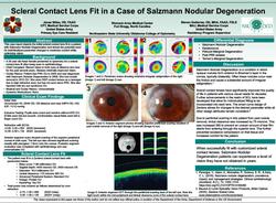 Scleral Contact Lens Fit in a Case of Salzmann Nodular Degeneration