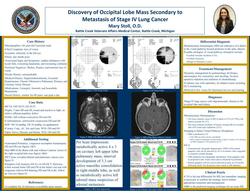 Discovery of Occipital Lobe Mass Secondary to Metastasis of Stage IV Lung Cancer