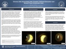 Chronic Iritis Associated with Complex Cataract Extraction and Scleral Fixed Intraocular Lens