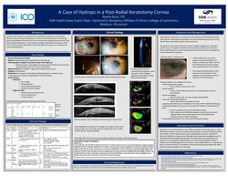 A Case of Hydrops in a Post-Radial Keratotomy Cornea