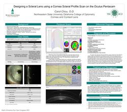 Designing a Scleral Lens using a Cornea Scleral Profile Scan on the Oculus Pentacam: A Case Report