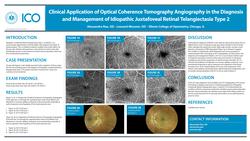Clinical Application of Optical Coherence Tomography Angiography in the Diagnosis and Management of Idiopathic Juxtafoveal Retinal Telangiectasia Type 2