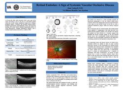 Retinal Embolus: A Sign of Systemic Vascular Occlusive Disease