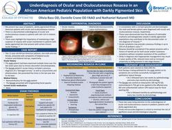 Underdiagnosis of ocular and oculocutaneous rosacea in an African American pediatric population with darkly pigmented skin.