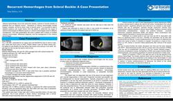 Recurrent hemorrhages from scleral buckle