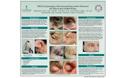 Office Cryosurgery: Non-aerosolizing Lesion Removal for ODs in the COVID-19 Era